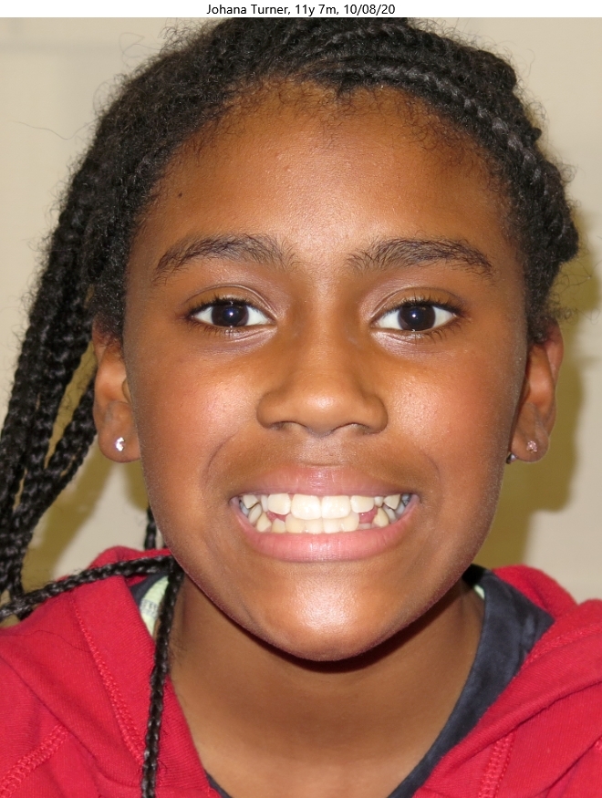 Before patient - Johana