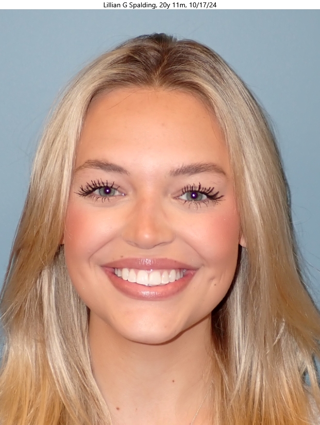 Before patient - Lillian