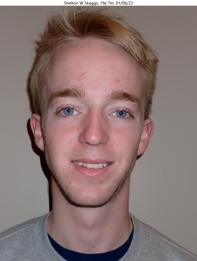 Before patient - Shelton