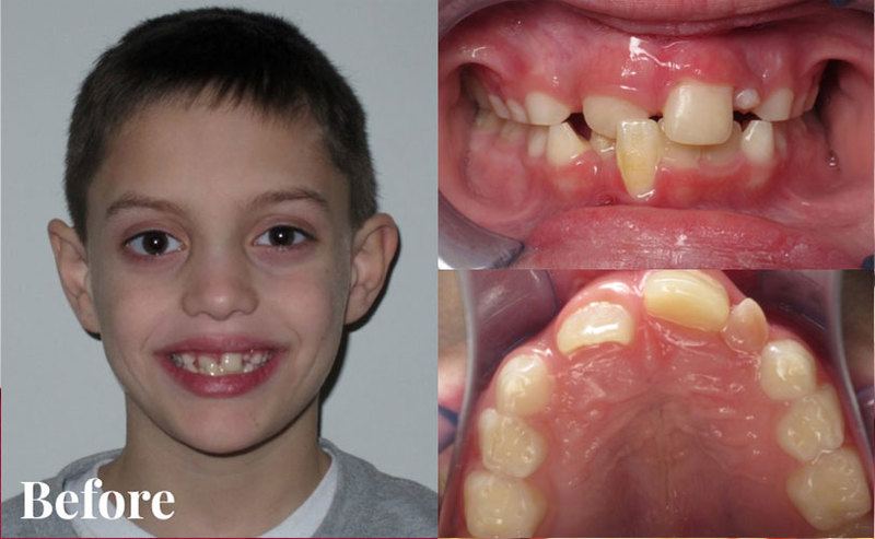 Before patient - Case G