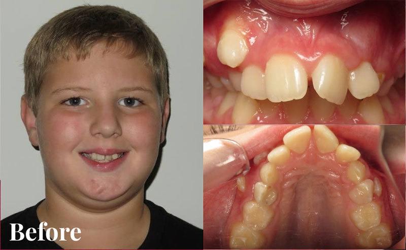 Before patient - Case H