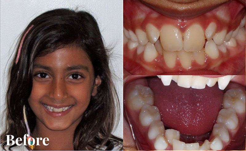 Before patient - Case I